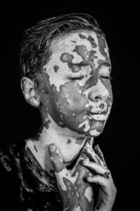 ニキビ跡の色素沈着を治療するための効果的な方法は？