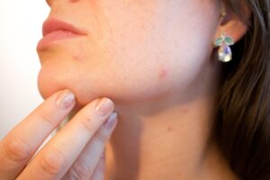 ニキビ治療で毛穴開きを改善できるか、実際の効果は？