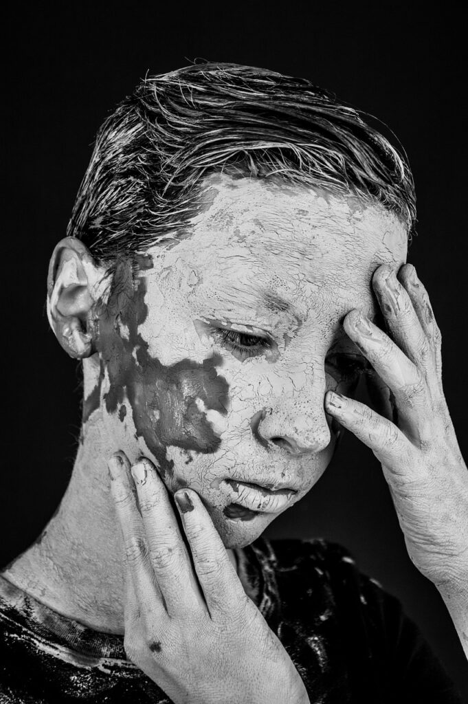 ニキビ跡の色素沈着を早く治す方法は？